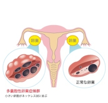 多嚢胞性卵巣症候群（PCOS）